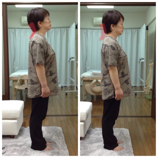 【整体コース】脊柱管狭窄症右側面のビフォアー・アフター