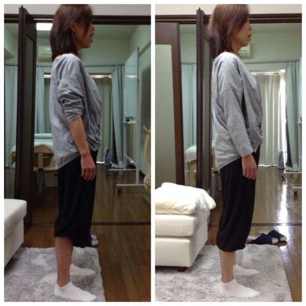 整体コース【腰痛】施術前後・右側面からのビフォアー・アフター